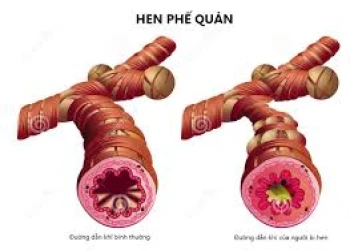 Phương pháp mới điều trị cho các bệnh như hen suyễn, COPD