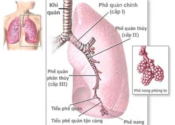 Bệnh viêm phế quản là gì và triệu chứng của bệnh