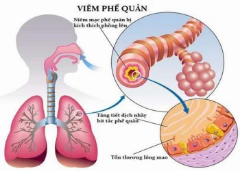 Nguyên nhân và cách điều trị bệnh viêm phế quản