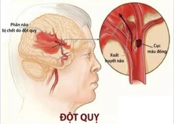 Các loại đột quỵ và nguyên nhân dẫn tới đột quỵ