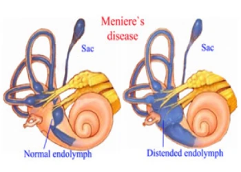 Nguyên nhân gây bệnh Meniere