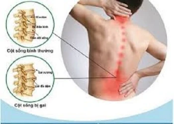 Những kiến thức về bệnh gai cột sống mà bạn cân biết