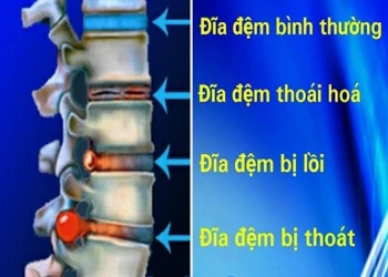 Những điều bạn cần biết về thoát vị đĩa đệm L5 – S1