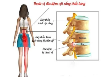 Thoát vị đĩa đệm cột sống là bệnh gì?