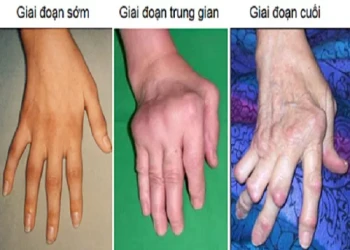 Tìm hiểu về bệnh viêm khớp dạng thấp